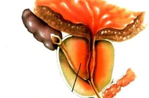 What is prostatitis in men