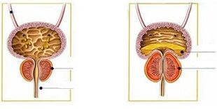 forms and forms of prostatitis in men