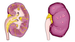 the cause of acute prostatitis