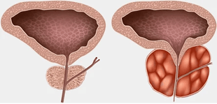 What is prostatic disease