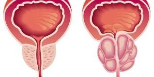 prostate inflammation