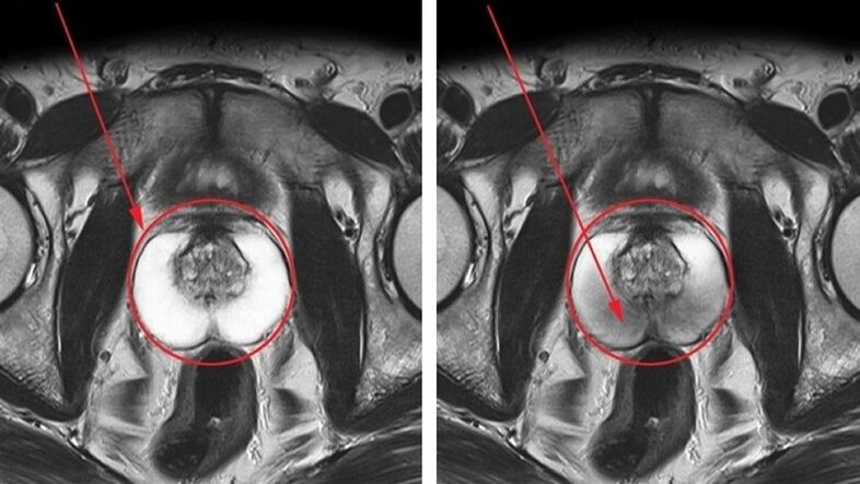 a healthy and inflamed prostate gland with chronic prostatitis