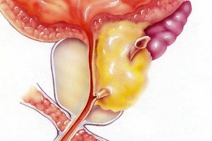 prostate inflammation