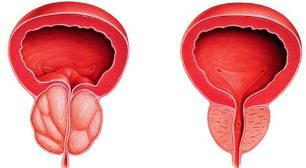 the difference is that the sick and the healthy prostate