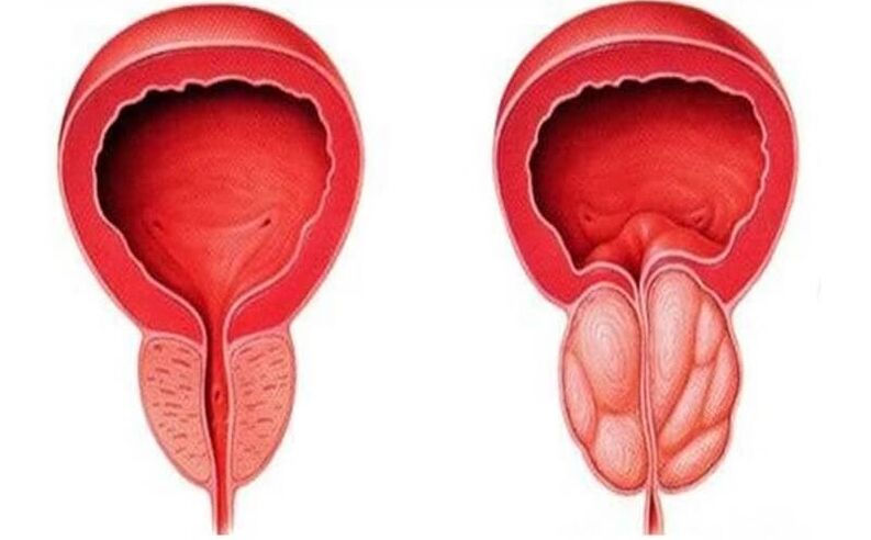 the prostate is healthy and inflamed with prostatitis